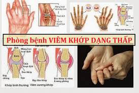 Những lời khuyên đầy đủ cho người bị viêm khớp dạng thấp: Từ ăn uống đến vận động và thuốc - Ảnh 3.