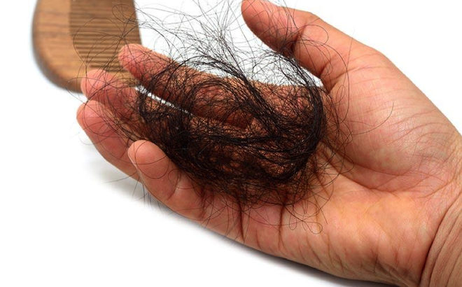 Rụng tóc bao nhiêu sợi trong một ngày bạn cần nghĩ tới vấn đề bệnh lý và nguy cơ hói đầu - Ảnh 1.