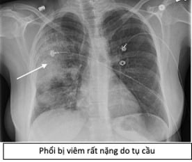 Bác sĩ BV Đại học Y Dược tiết lộ 1 cửa ngõ giúp vi khuẩn tấn công phổi rất ít người biết - Ảnh 1.
