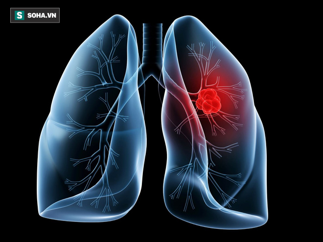 Mỗi năm TQ có 780.000 người mắc ung thư phổi: BS khuyên 3 việc không nên làm trước khi ngủ - Ảnh 1.