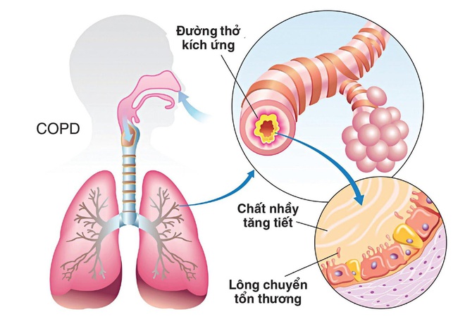 Nếu cơ thể có 2 chỗ lồi và 3 chỗ đen sạm: Bệnh phổi đang điểm danh bạn, hãy đi khám - Ảnh 1.