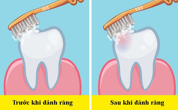 Các nha sĩ trả lời câu hỏi &quot;dễ mà khó&quot;: Nên đánh răng trước hay sau bữa ăn sáng?