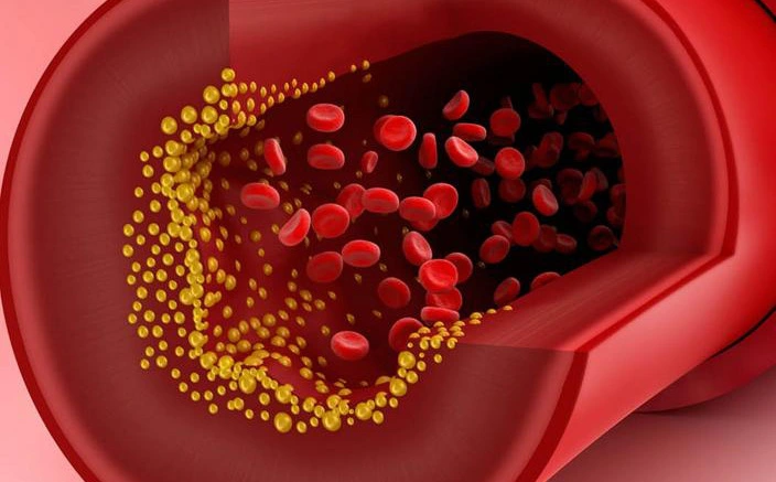 Mỡ máu cao có thể dẫn đến tắc mạch máu, đột tử: 4 