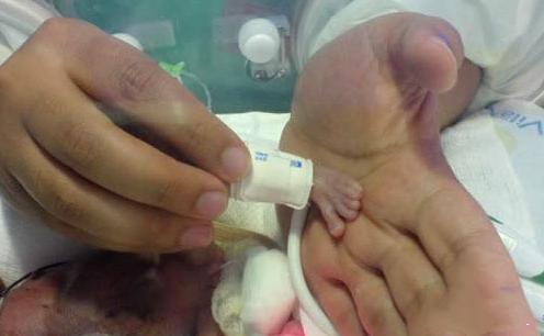 Em bé nhẹ nhất thế giới: Chào đời chỉ nặng 3 lạng, ngoại hình sau 15 năm gây choáng ngợp - Ảnh 4.