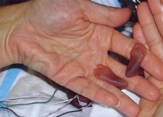 Em bé nhẹ nhất thế giới: Chào đời chỉ nặng 3 lạng, ngoại hình sau 15 năm gây choáng ngợp - Ảnh 3.