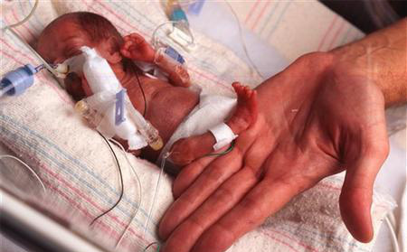 Em bé nhẹ nhất thế giới: Chào đời chỉ nặng 3 lạng, ngoại hình sau 15 năm gây choáng ngợp