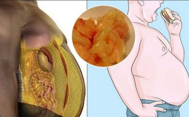 Người béo phì thừa cân chiếm tỉ lệ tử vong vì Covid-19 cao: BS cảnh báo điều nên làm ngay