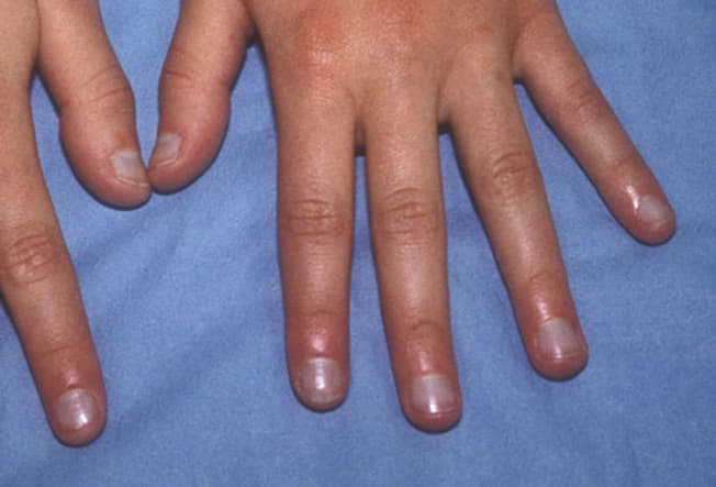 10 dấu hiệu cảnh báo bệnh tật trên móng tay: Từ bệnh tim, gan, thận đến cả ung thư - Ảnh 5.