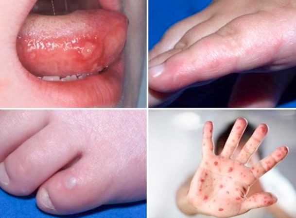 Trẻ mắc tay chân miệng gia tăng: Bác sĩ cảnh báo triệu chứng cha mẹ không được bỏ qua - Ảnh 2.