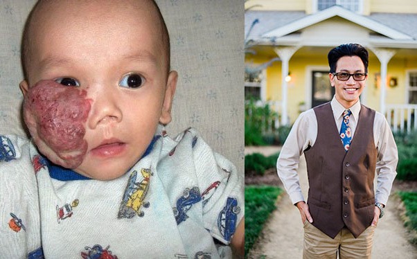 Cậu bé gốc Việt bị khối u che nửa mặt, thoi thóp trong cô nhi viện được tái sinh nhờ mẹ Mỹ