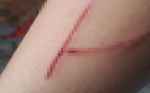 Bé gái 15 tuổi trong vụ án hiếp dâm ở Bình Chánh tự lấy dao rạch gây thương tích vào tay, không phải bị chém