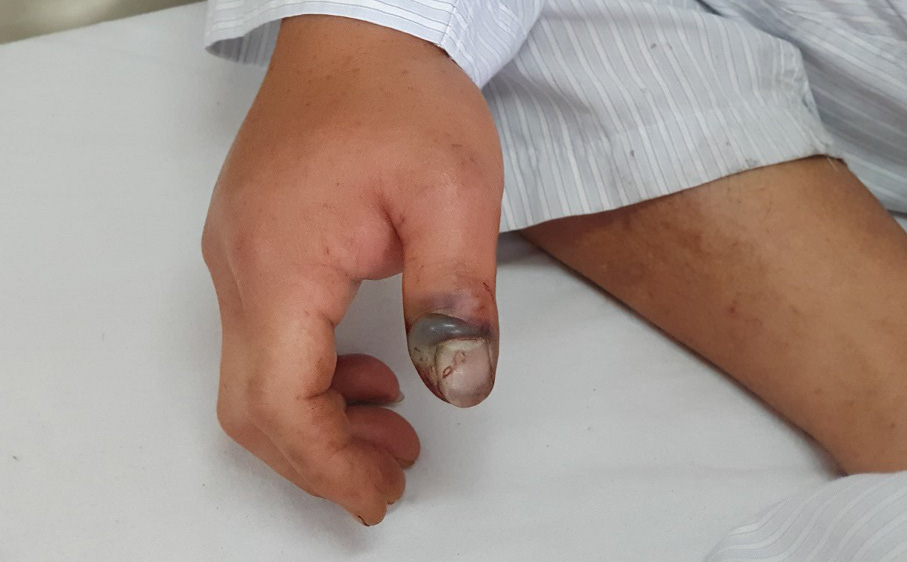 Liên tục ca bị rắn độc cắn vào mùa hè: GĐ Trung tâm Chống độc Bệnh viện Bạch Mai chỉ lý do