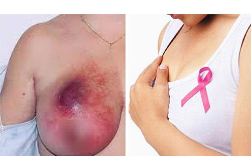 &quot;Dính&quot; 6 thói quen làm tăng nguy cơ ung thư vú: Thói quen thứ 6 rất nhiều phụ nữ mắc