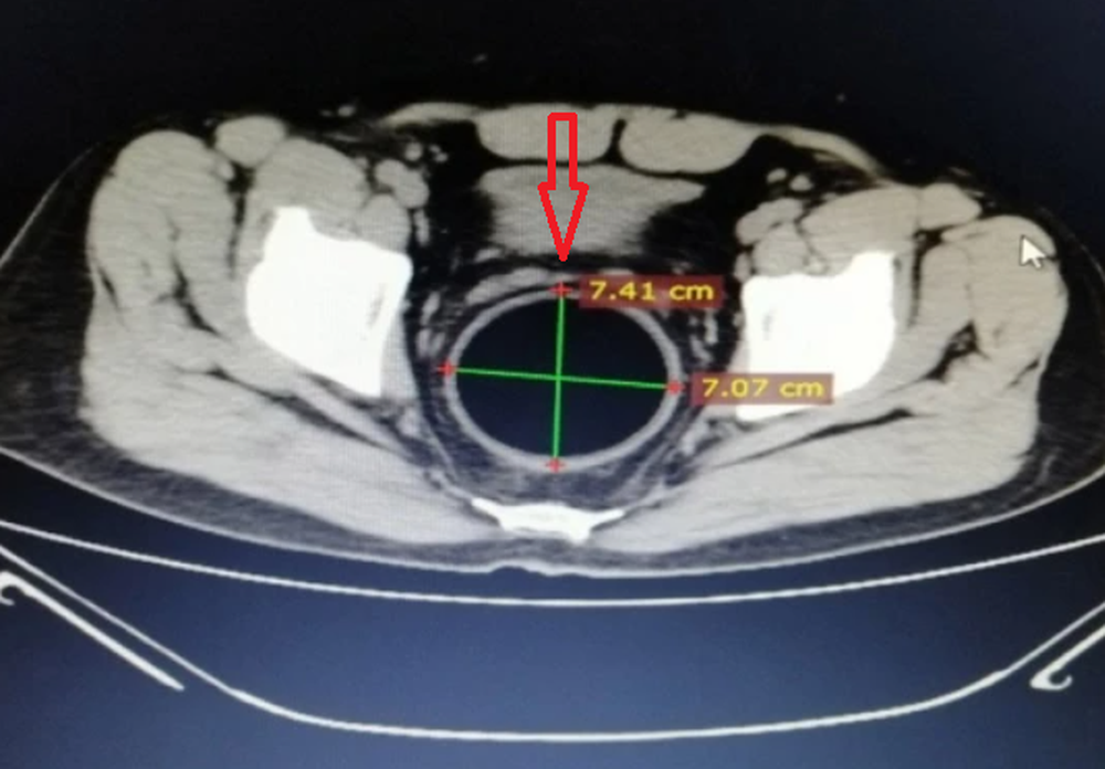 Đến viện vì đau bụng đến phát khóc, vật lấy từ bụng bệnh nhân khiến ai nấy đều sững sờ - Ảnh 4.