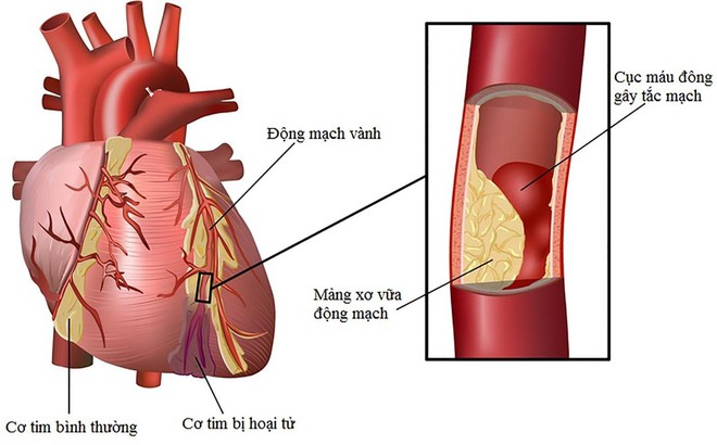 Sau khi uống rượu, nếu có 3 dấu hiệu này thì hãy cẩn thận với bệnh mỡ máu đang tiến triển - Ảnh 2.